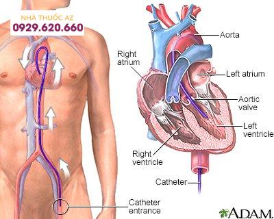 hội chứng ALCAPA