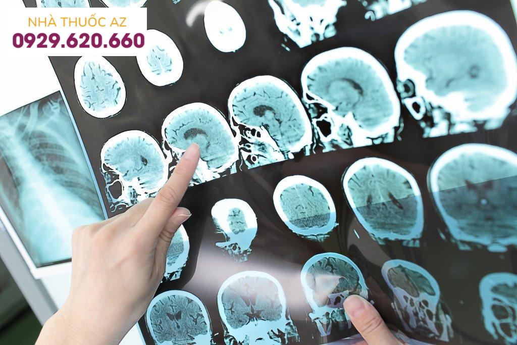 Bệnh mạch máu tinh bột có tên tiếng anh là amyloid angiopathy