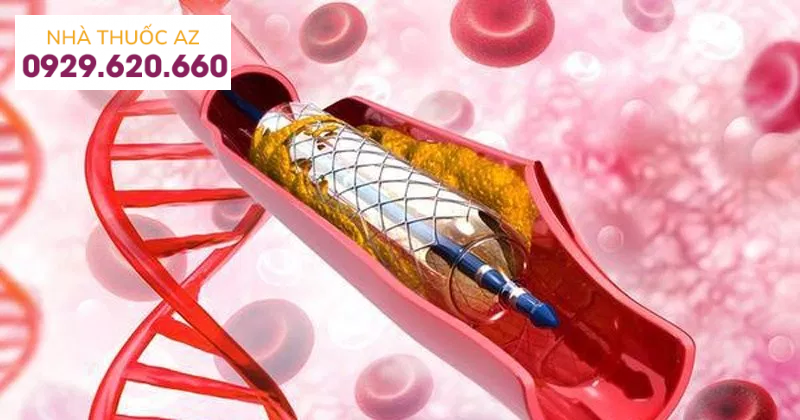 Can thiệp động mạch thận bằng cách nong mạch với đặt stent