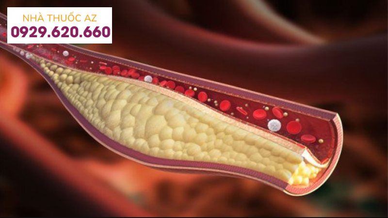 Đặt stent động mạch thận để mở rộng lòng động mạch thận