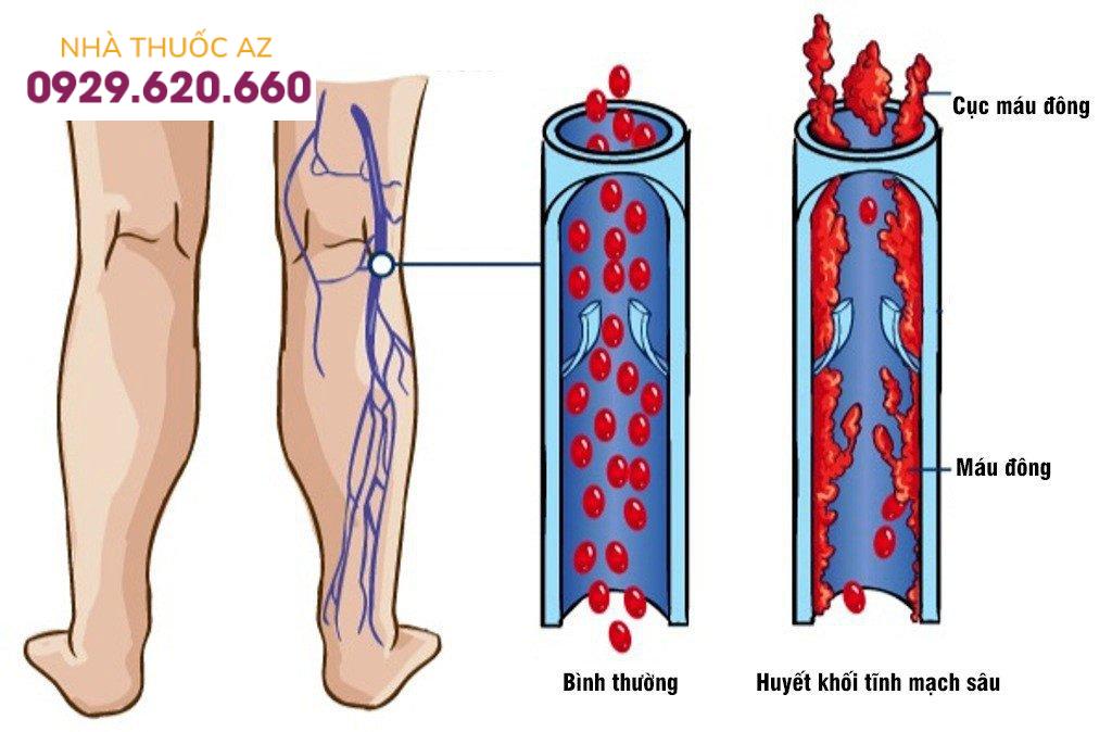 Bệnh học huyết khối tĩnh mạch sâu chi dưới là tình trạng cục máu đông hình thành ở sâu trong tĩnh mạch