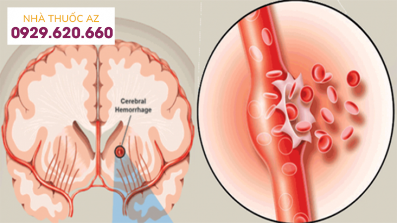 Nguyên nhân thường gặp của xuất huyết mạch máu là rối loạn protein máu