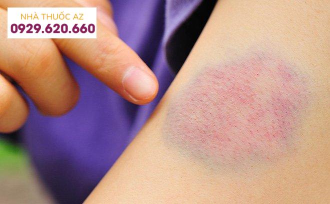 Mảng bầm dưới da có thể là do xuất huyết mạch máu