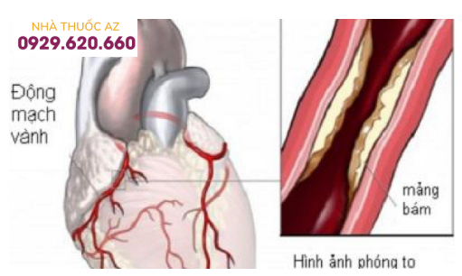Tắc động mạch thận cấp tính thường gặp nhất là thuyên tắc mảng xơ vữa động mạch