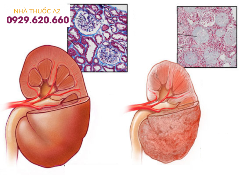 Xơ cứng thận lành tính là tình trạng tổn thương thận lâu dài