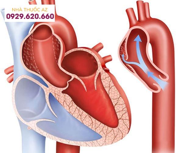Bóc tách động mạch chủ ngực gây cơn đau ngực nguy hiểm