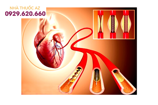 Đặt stent động mạch là