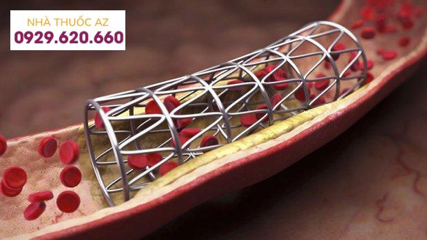 đặt stent mạch vành được bao lâu