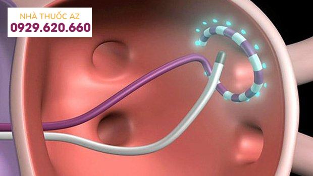 Điều trị rung nhĩ