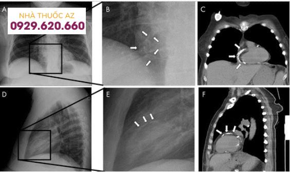 vôi hóa mạch vành