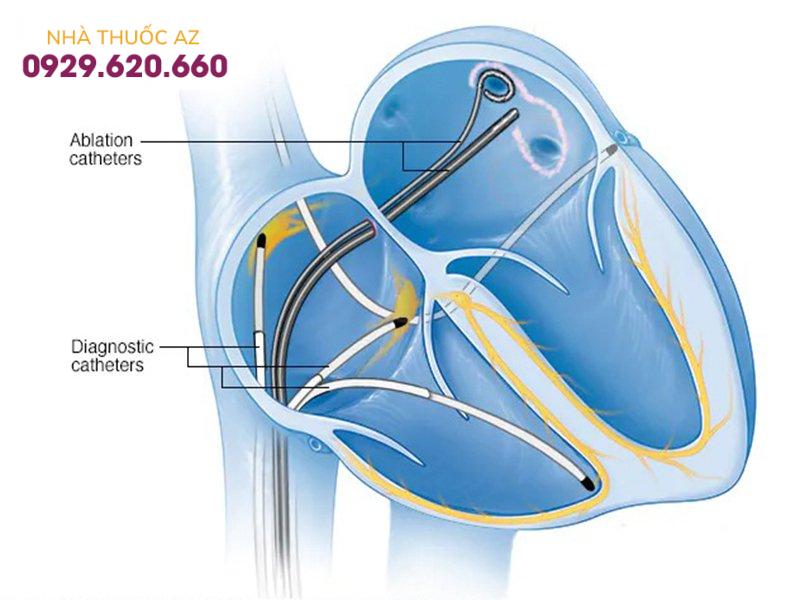 Cắt đốt bằng ống thông