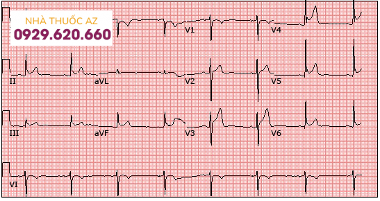 Tái cực sớm trên ECG 12 chuyển đạo và theo dõi tái cực sớm lành tính 3 mm ở các chuyển đạo bên và dưới.