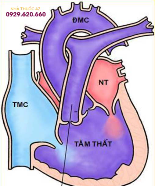 Hình ảnh mô phỏng tim một thất