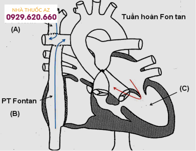 Phẫu thuật Fontan