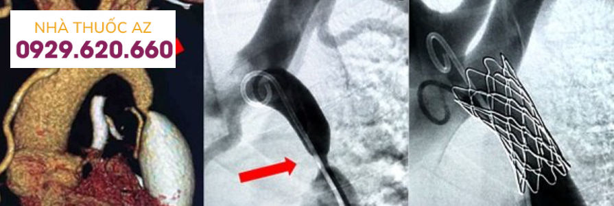 Hình ảnh trước và sau nong hẹp eo động mạch chủ