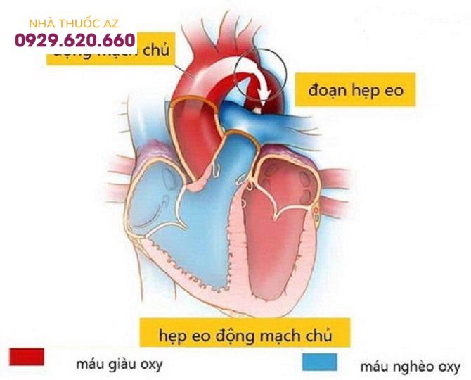 Hình ảnh trước và sau nong hẹp eo động mạch chủ