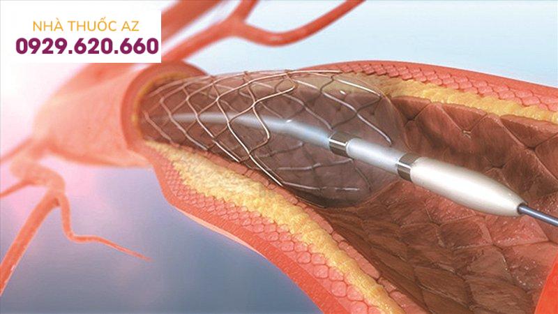 Nong mạch vành điều trị hẹp động mạch vành giúp cải thiện tình trạng đau thắt ngực
