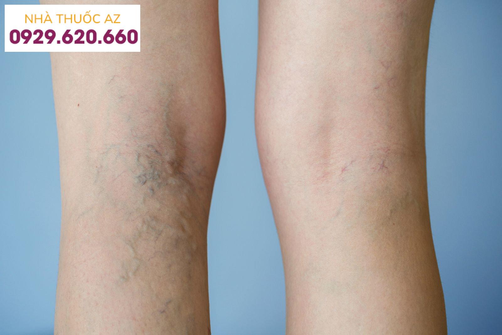 có mấy loại suy giãn tĩnh mạch