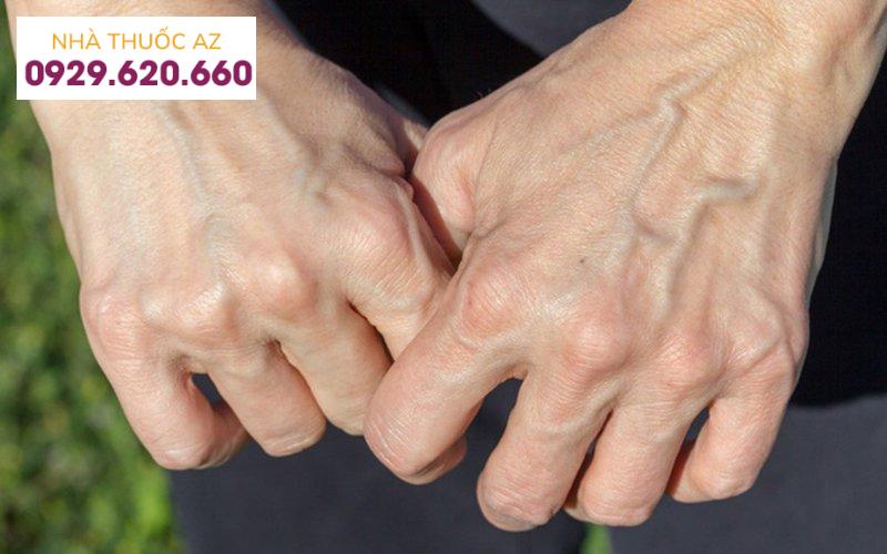 Dấu hiệu suy giãn tĩnh mạch tay