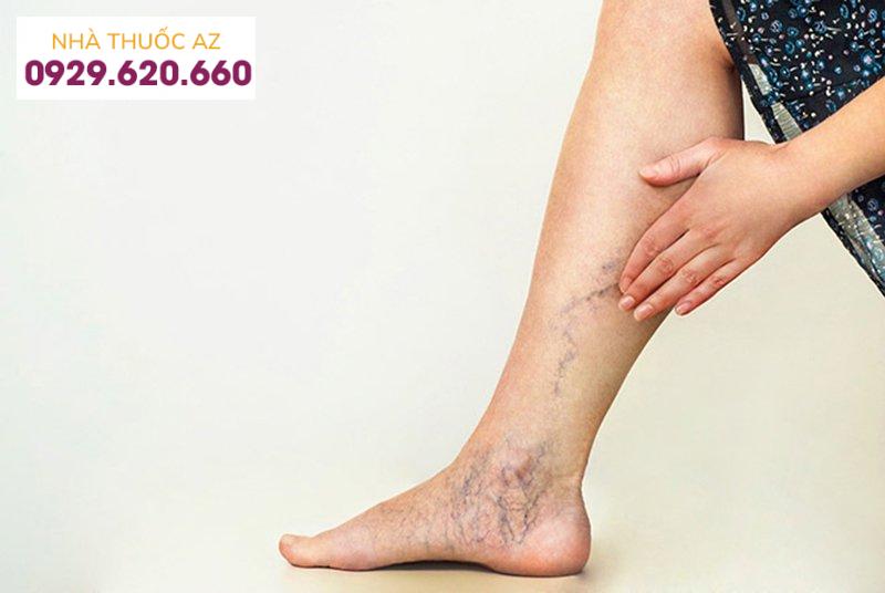 Bệnh suy giãn tĩnh mạch chi dưới