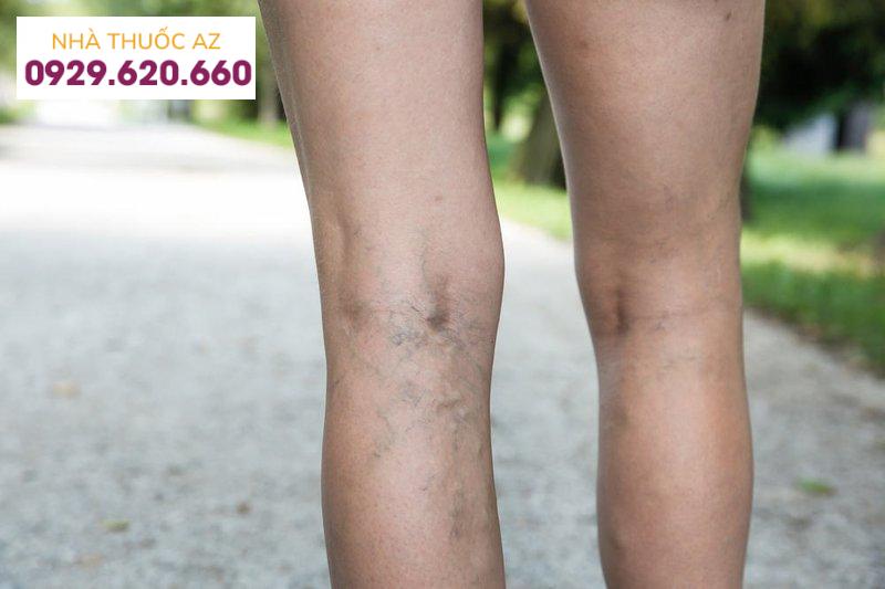 suy giãn tĩnh mạch có nên đi bộ không