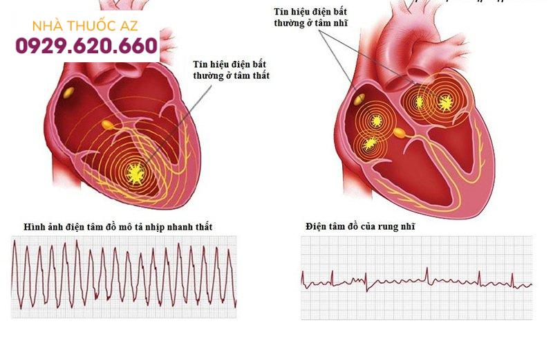 Rối loạn nhịp tim