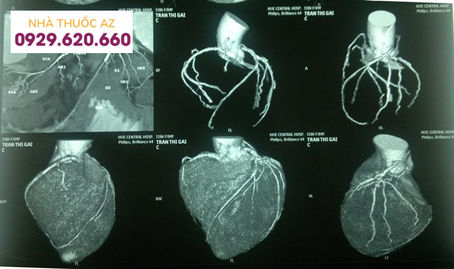 Chụp động mạch vành tại Bệnh viện Đa khoa Quốc tế Vinmec