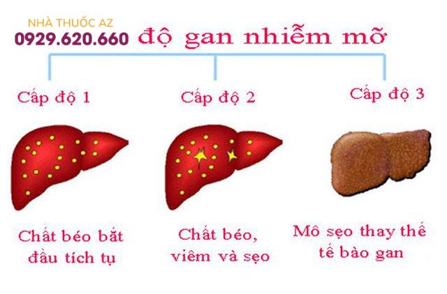 gan nhiễm mỡ