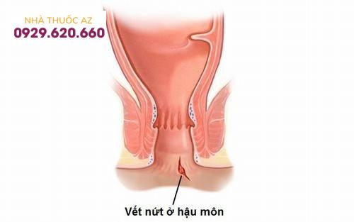 Nứt kẽ hậu môn