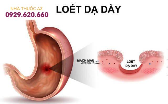 Thủng ổ loét dạ dày - tá tràng: Biến chứng nguy hiểm của viêm loét dạ dày - tá tràng