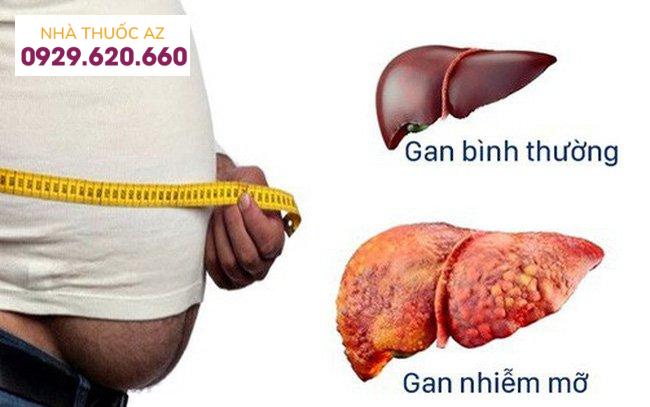 Gan nhiễm mỡ không do rượu: Nguyên nhân, triệu chứng, biến chứng