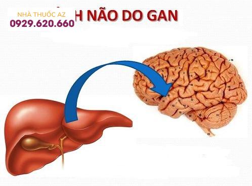 Bệnh lý não gan là gì?