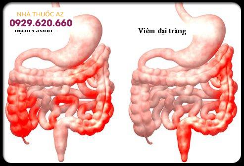Hội chứng Crohn