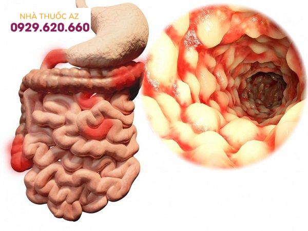 Bệnh Crohn có nguy hiểm không