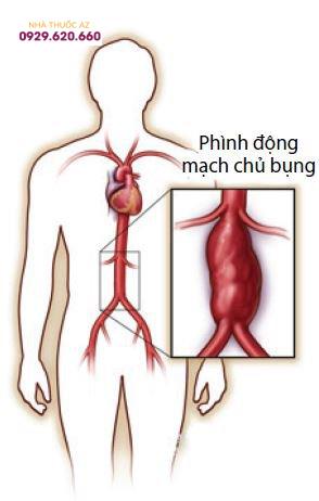 Phình động mạch chủ bụng