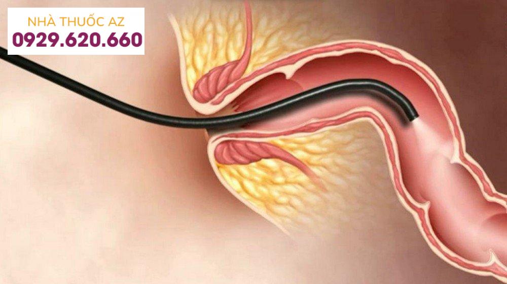 Nội soi trực tràng ống cứng