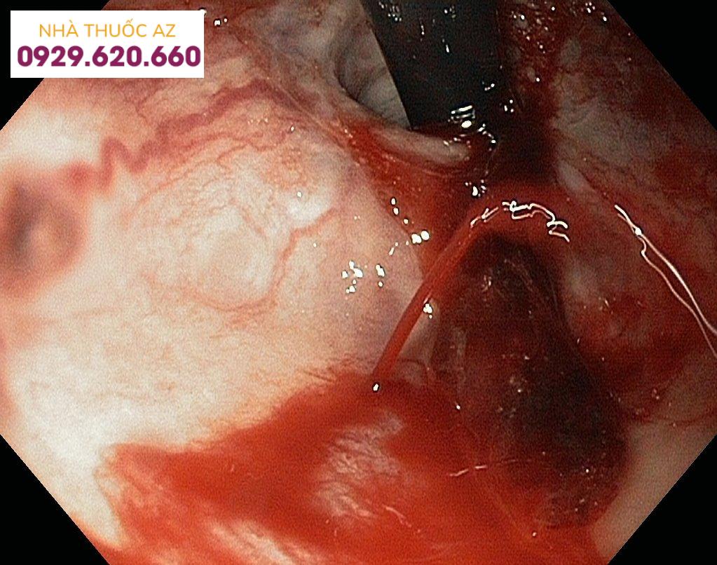 Hình ảnh nội soi của vỡ tĩnh mạch thực quản