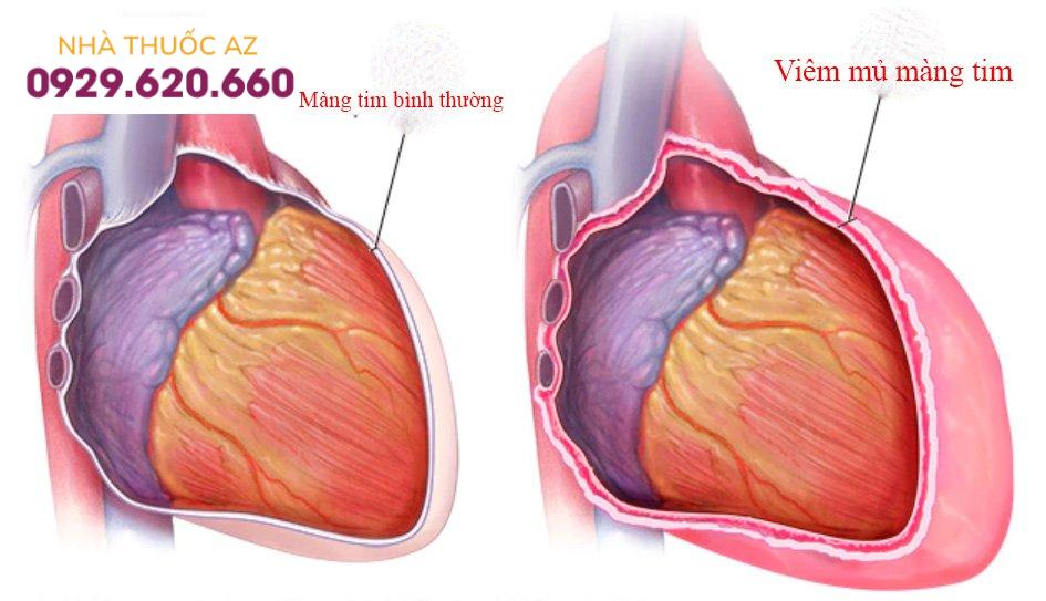 Viêm mủ ngoài màng tim