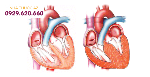 Phì đại thất trái