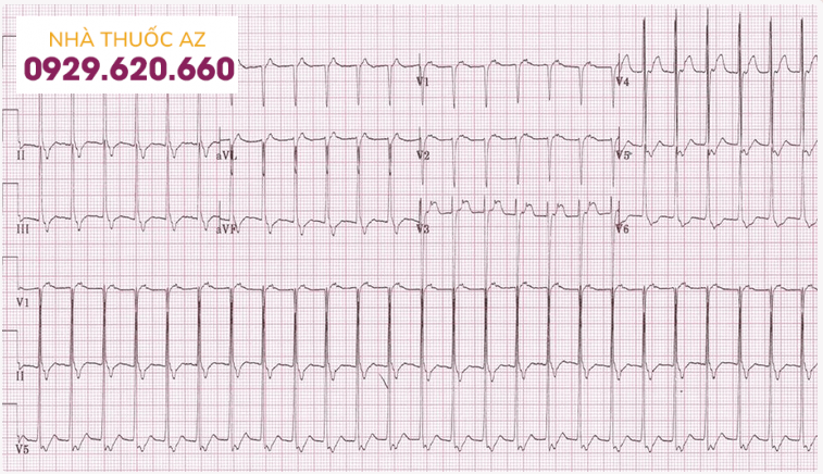 Nhịp nhanh trên thất
