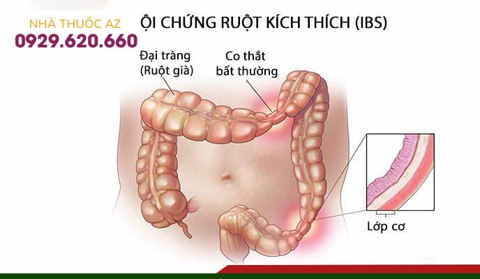 hội chứng ruột kích thích