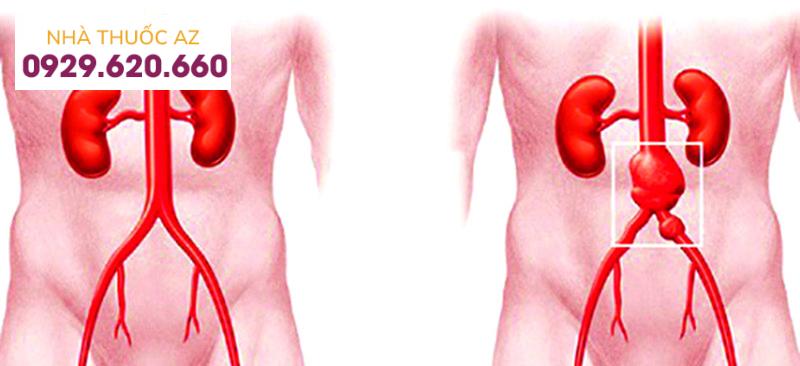 phình động mạch chủ