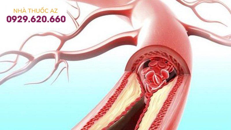 thiếu máu cục bộ