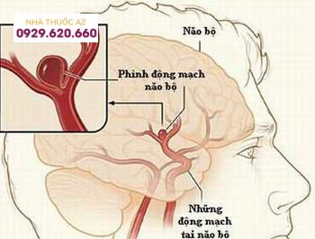phình động mạch não