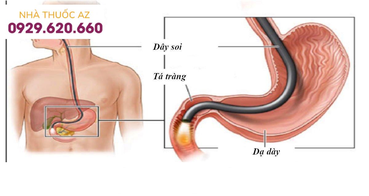Nội soi dạ dày thực quản