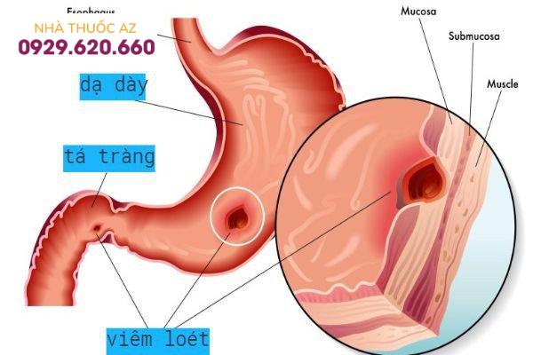 Viêm loét dạ dày