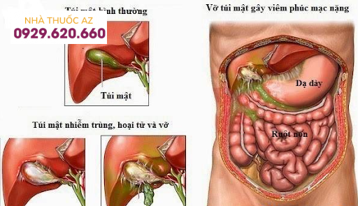 Viêm phúc mạc mật
