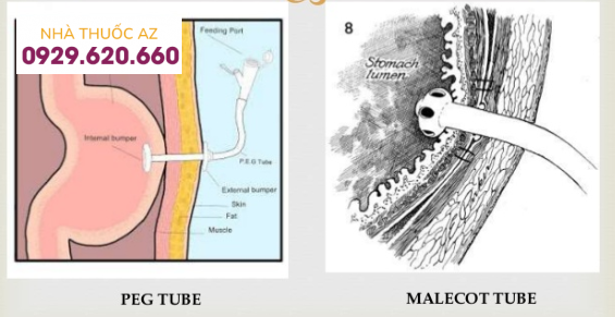 Mở thông dạ dày