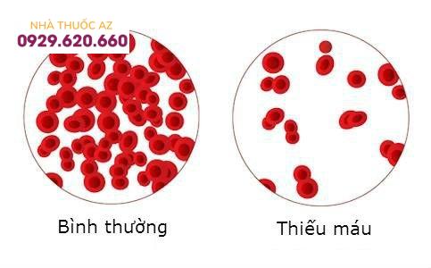 thiếu máu