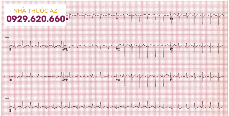 Nhịp nhanh xoang tần số 150 chu kỳ/phút